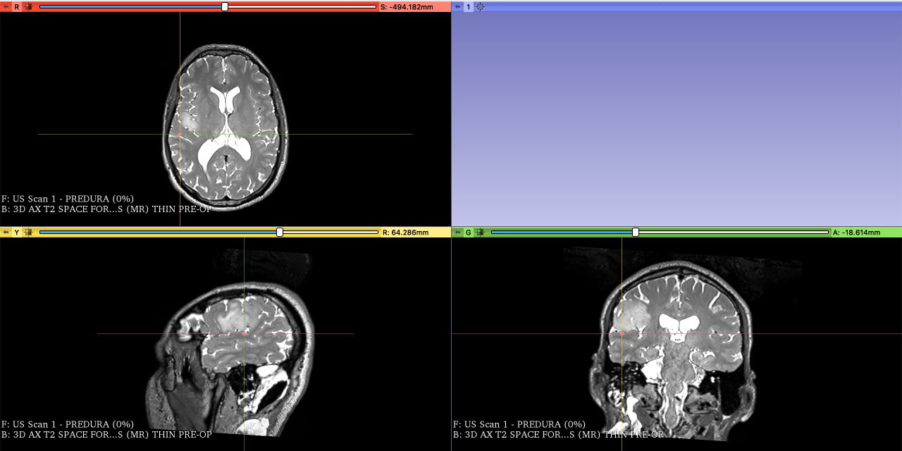 Picture of the fiducial on the T2 pre-operative MRI image located on a sulcus